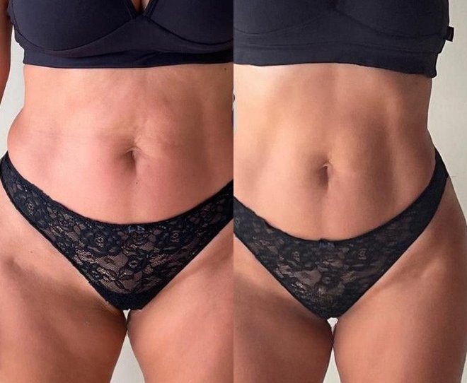 Antes e depois Flexihome